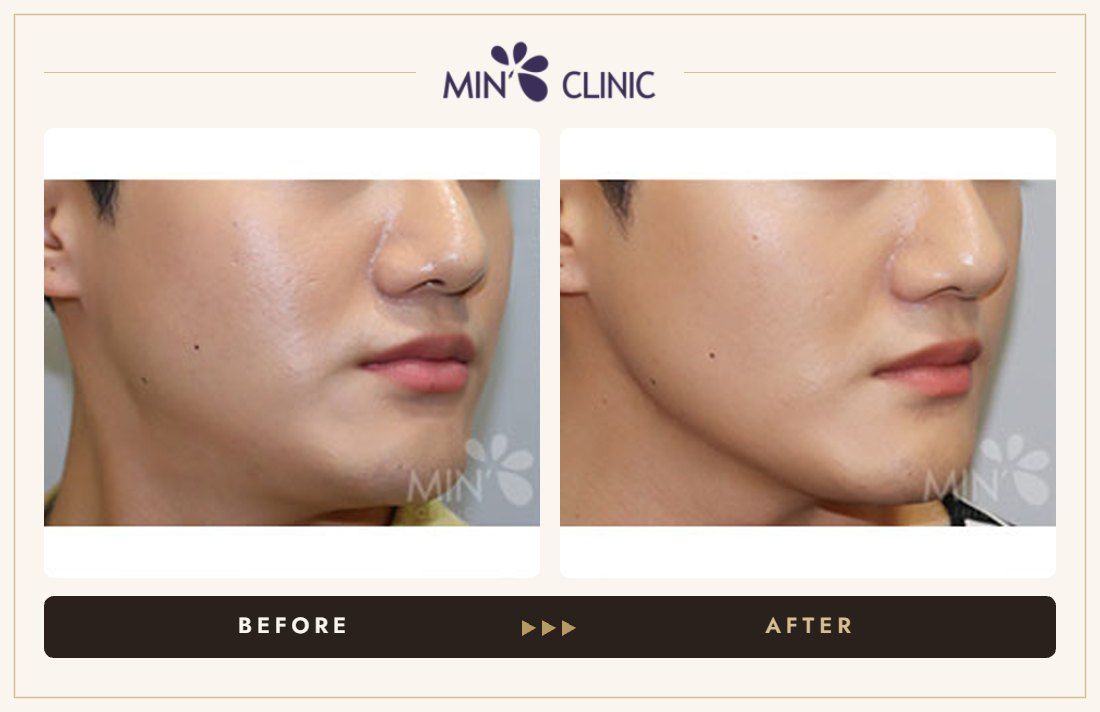 Quick Slim before and after – MIN Clinic Gangnam, Seoul