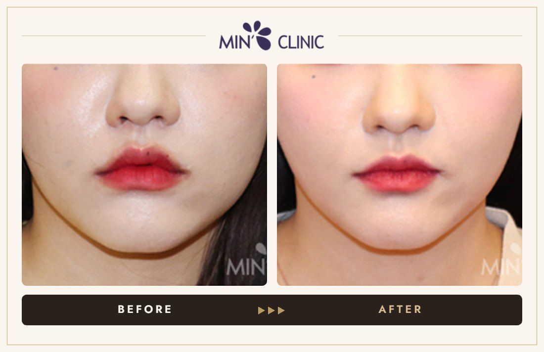 V-line Quick Slim before and after, case 12 – MIN Clinic Seoul
