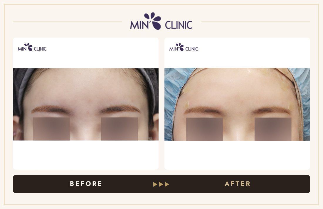 Temple filler before and after, case 2 – MIN Clinic Seoul