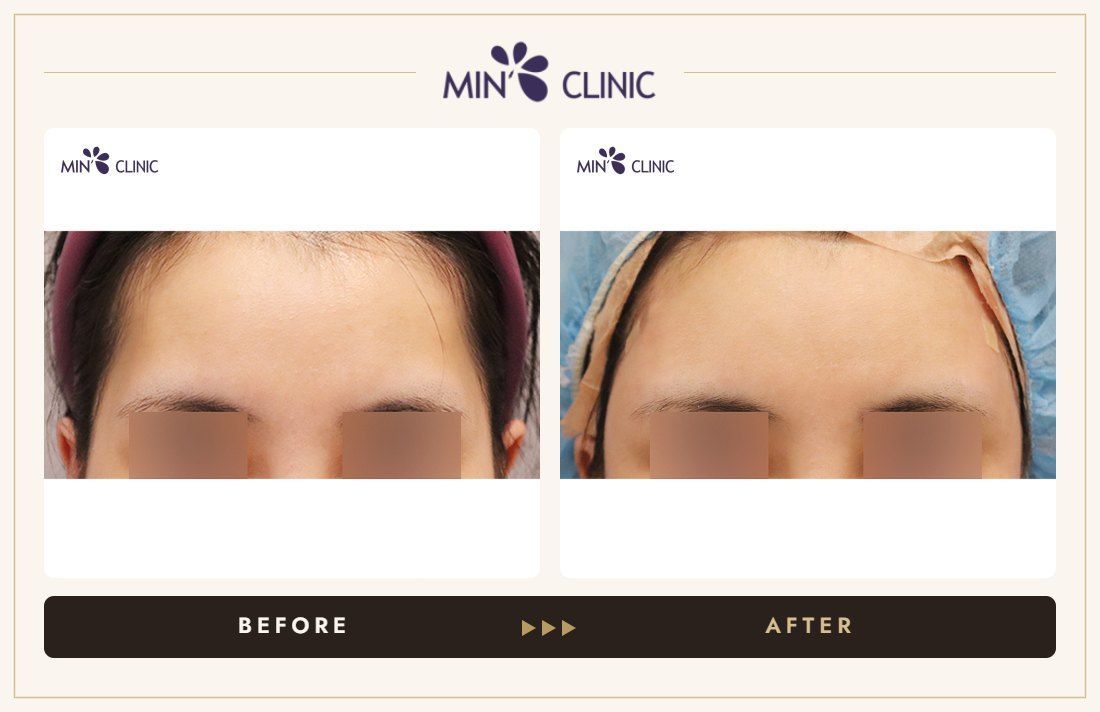Temple filler before and after, case 3 – MIN Clinic Seoul