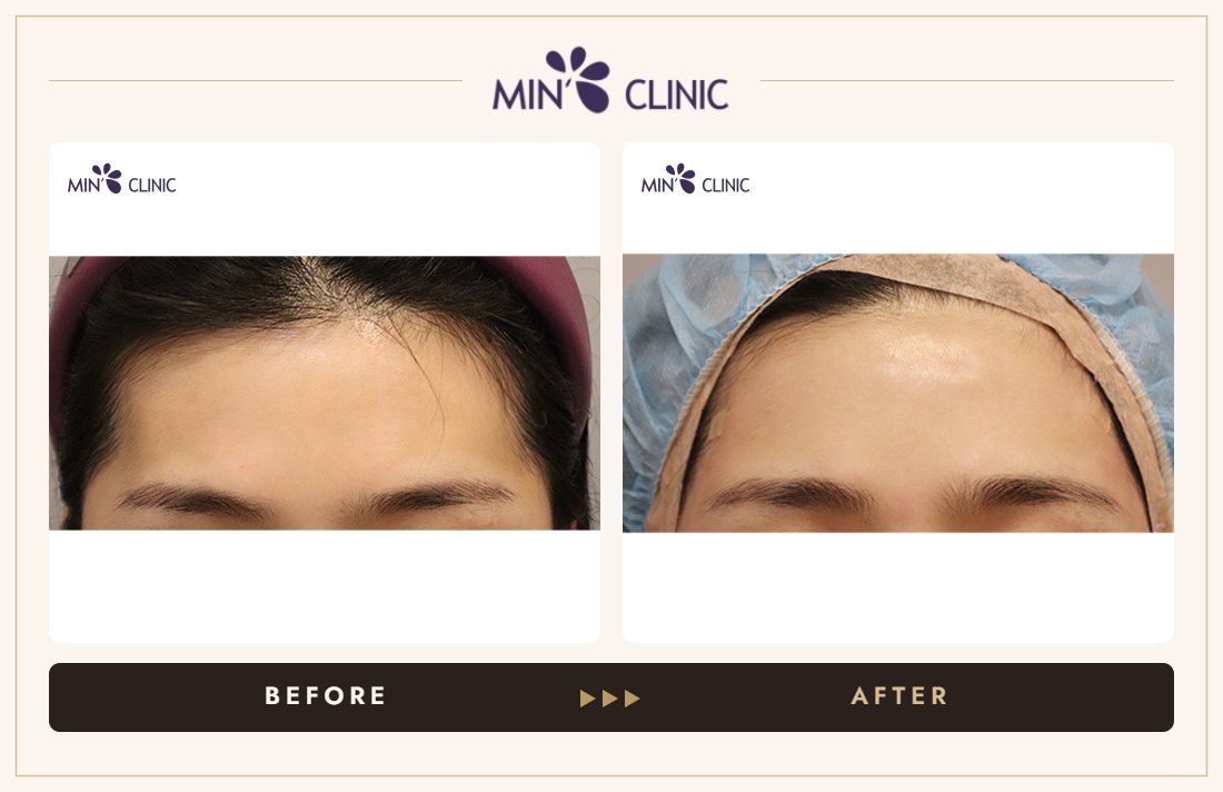 Temple filler before and after, case 4 – MIN Clinic Seoul