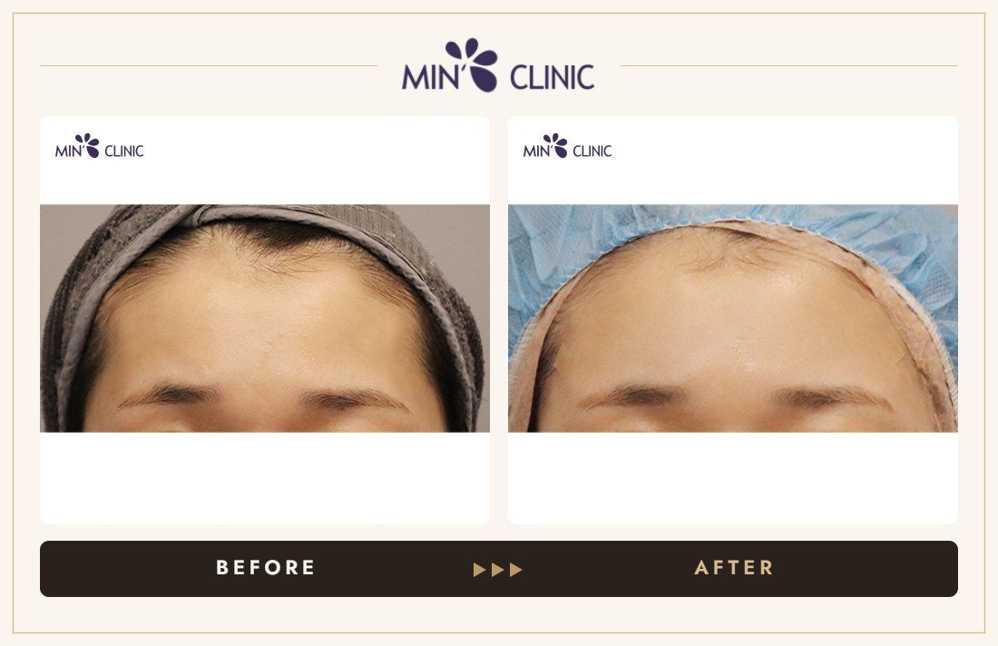 Temple filler before and after – MIN Clinic Gangnam, Seoul