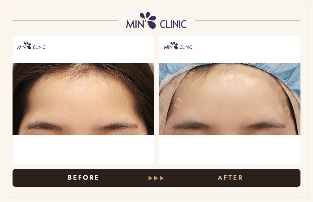 Temple filler before and after, case 1 – MIN Clinic Seoul