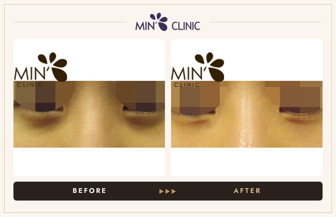 Tear trough + nose filler before and after, case 3 – MIN Clinic Seoul