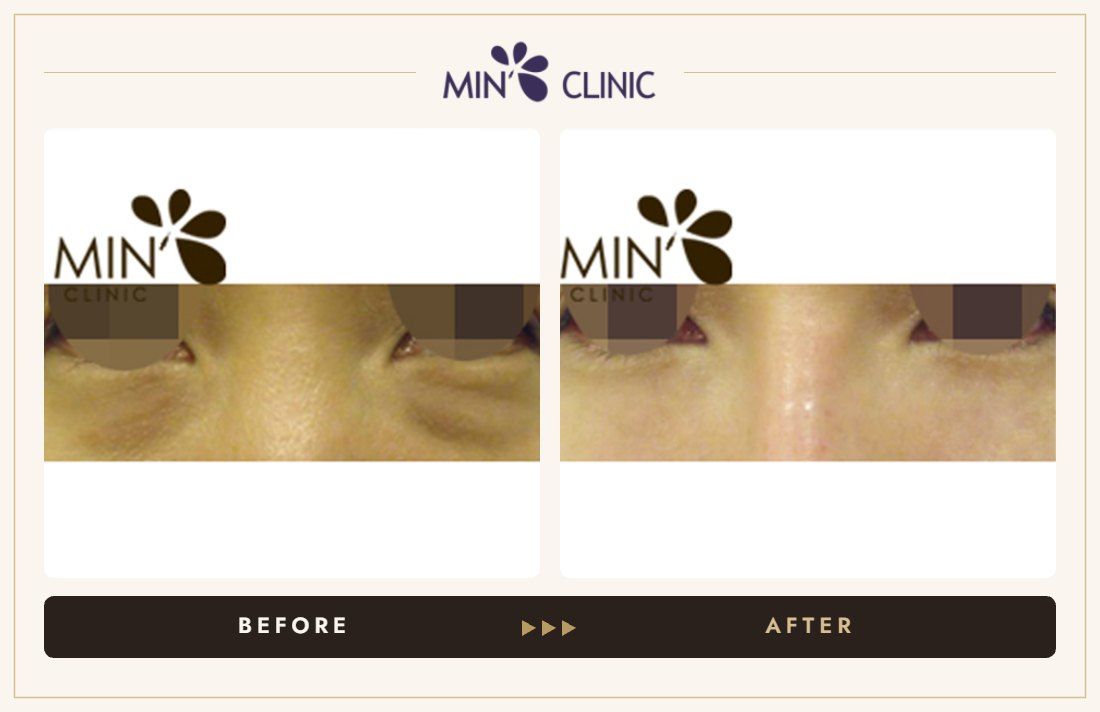 Tear trough + nose filler before and after, case 4 – MIN Clinic Seoul
