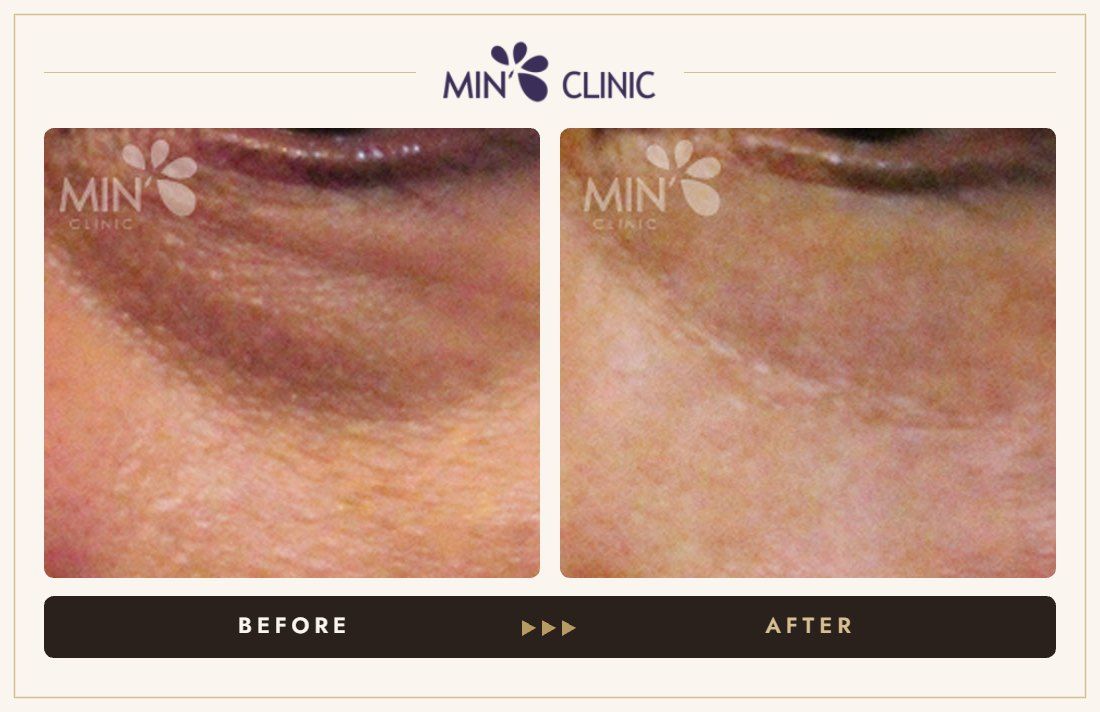 Tear trough filler before and after, case 6 – MIN Clinic Seoul