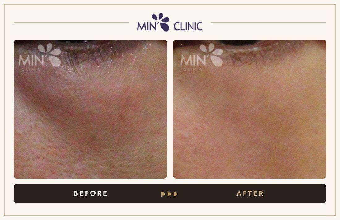 Tear trough filler before and after, case 7 – MIN Clinic Seoul