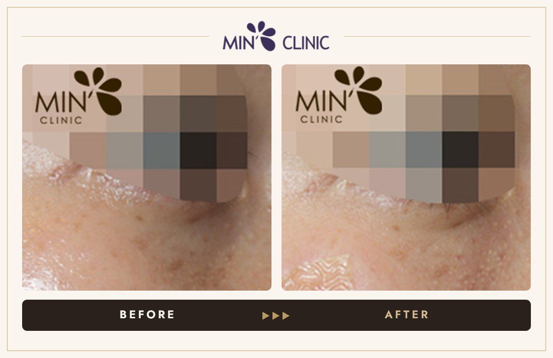 Tear trough filler before and after, case 8 – MIN Clinic Seoul
