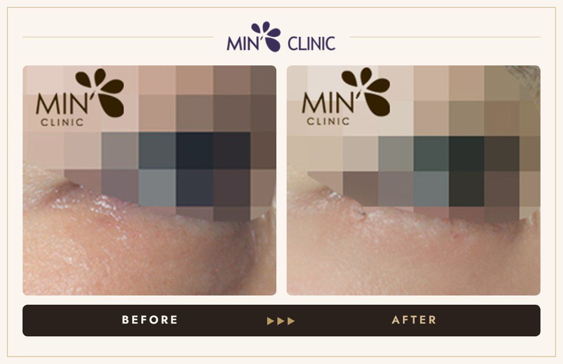 Tear trough filler before and after, case 10 – MIN Clinic Seoul