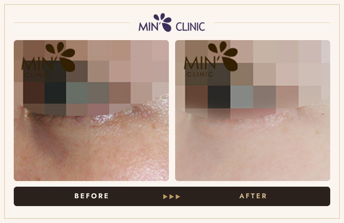 Tear trough filler before and after, case 11 – MIN Clinic Seoul