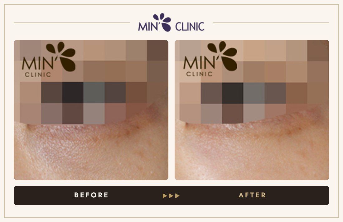 Tear trough filler before and after, case 12 – MIN Clinic Seoul
