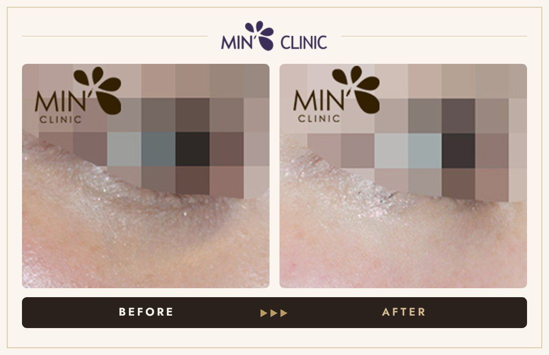 Tear trough filler before and after, case 13 – MIN Clinic Seoul