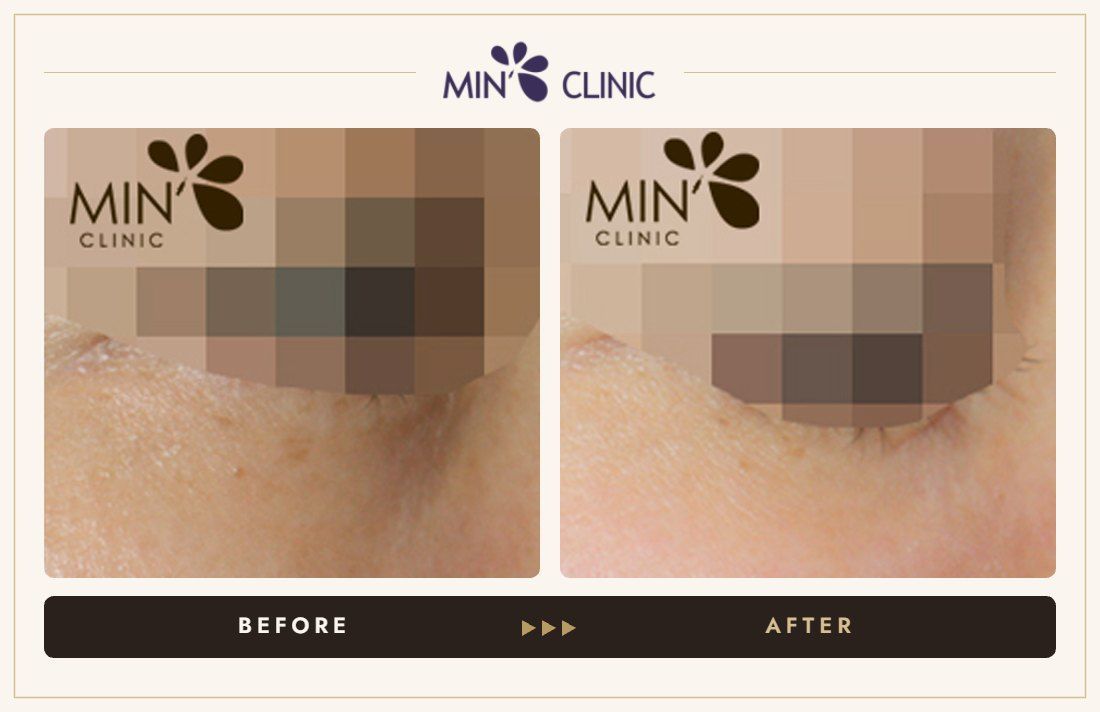 Tear trough filler before and after, case 14 – MIN Clinic Seoul