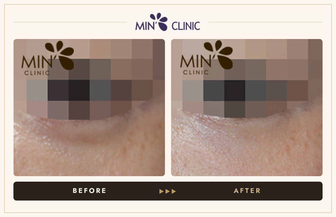 Tear trough filler before and after, case 15 – MIN Clinic Seoul
