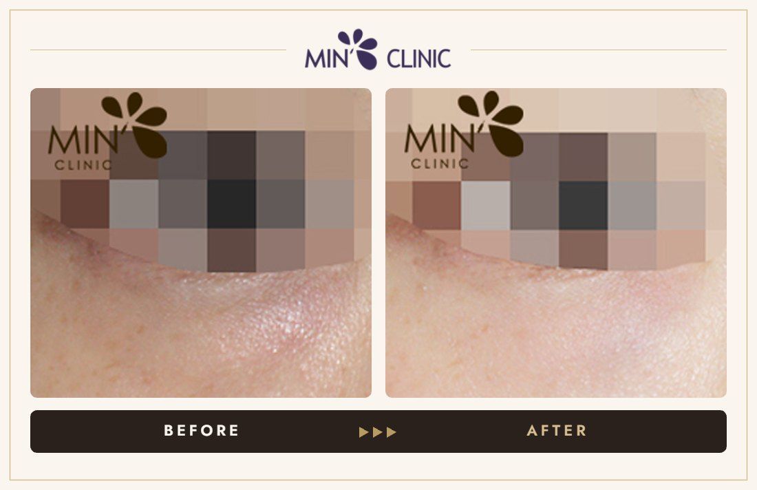 Tear trough filler before and after, case 16 – MIN Clinic Seoul