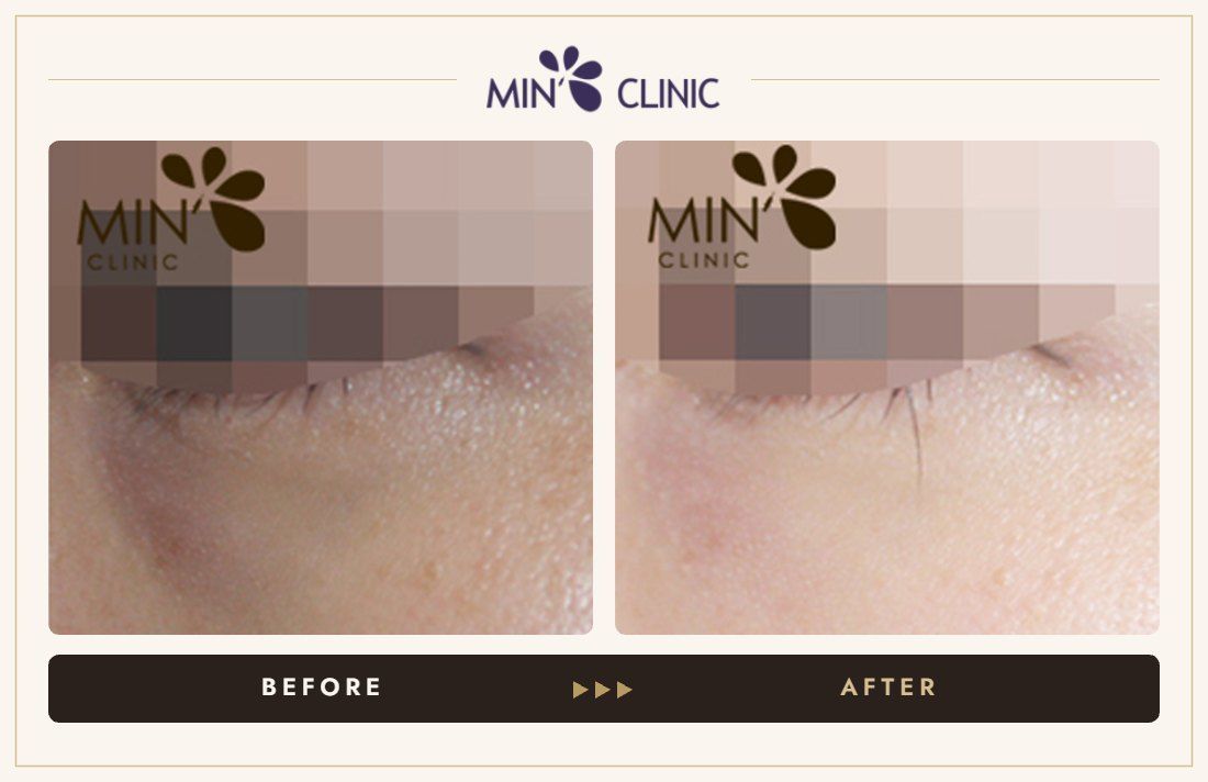Tear trough filler before and after, case 17 – MIN Clinic Seoul