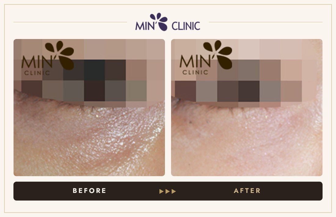 Tear trough filler before and after, case 18 – MIN Clinic Seoul
