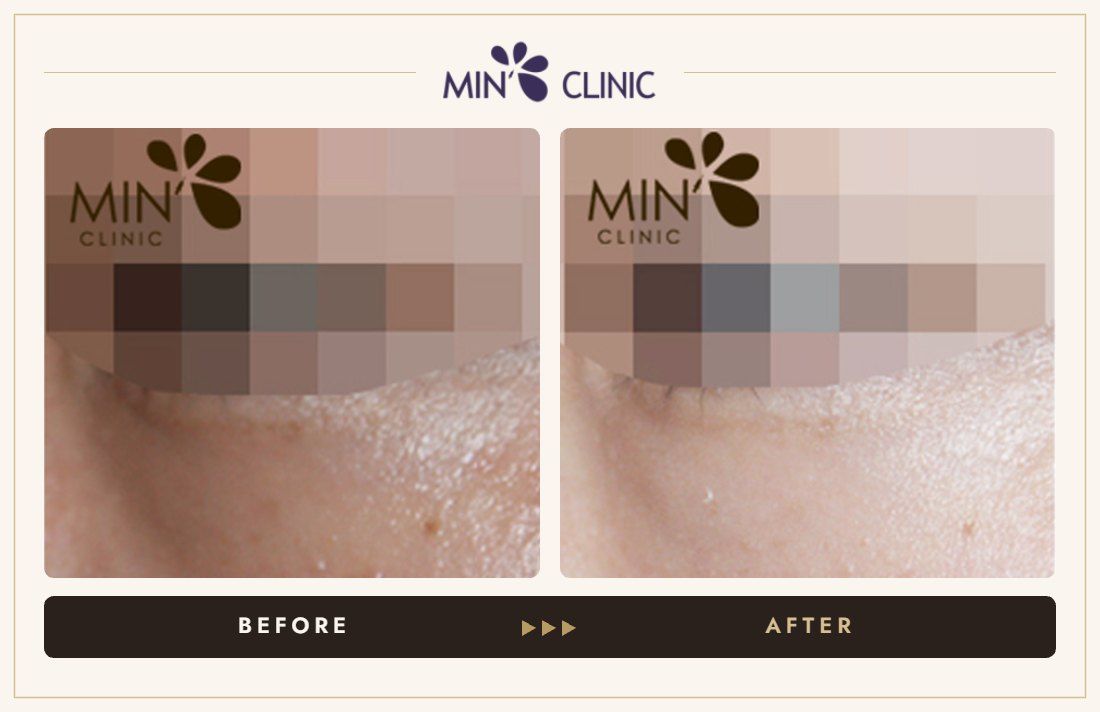 Tear trough filler before and after, case 19 – MIN Clinic Seoul