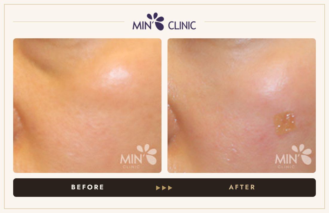 Tear trough filler before and after, case 20 – MIN Clinic Seoul