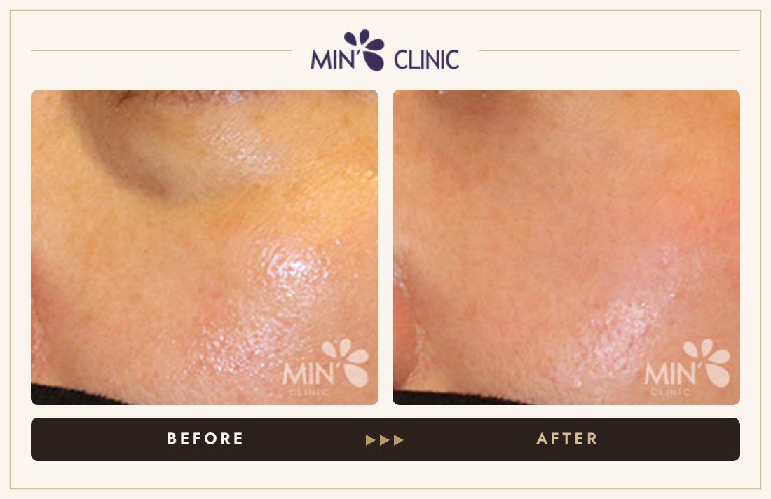 Tear trough filler before and after, case 21 – MIN Clinic Seoul