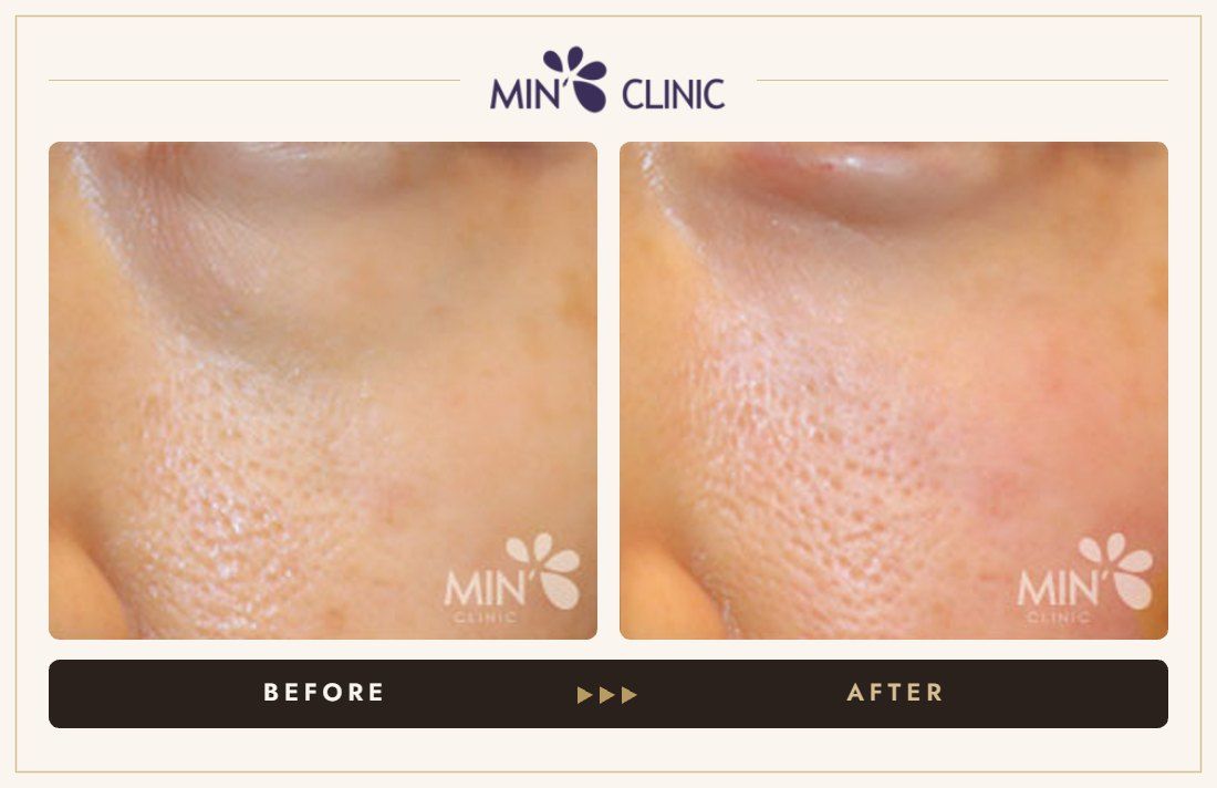 Tear trough filler before and after – MIN Clinic Gangnam, Seoul