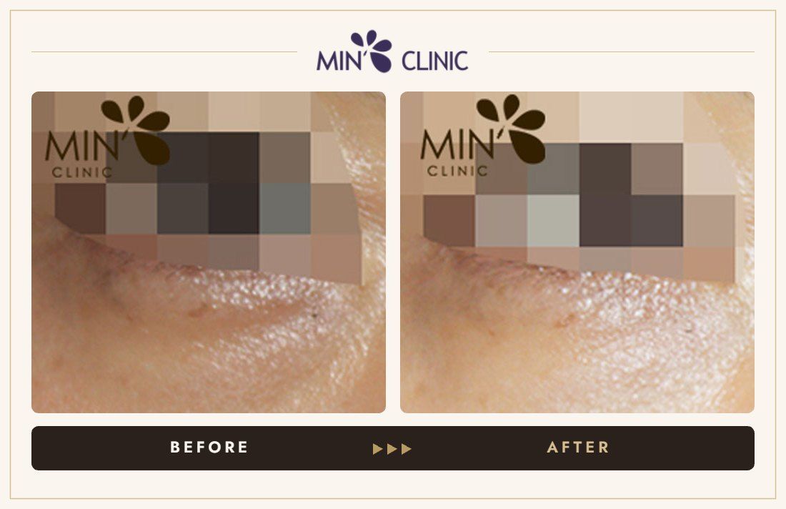 Tear trough filler before and after, case 5 – MIN Clinic Seoul