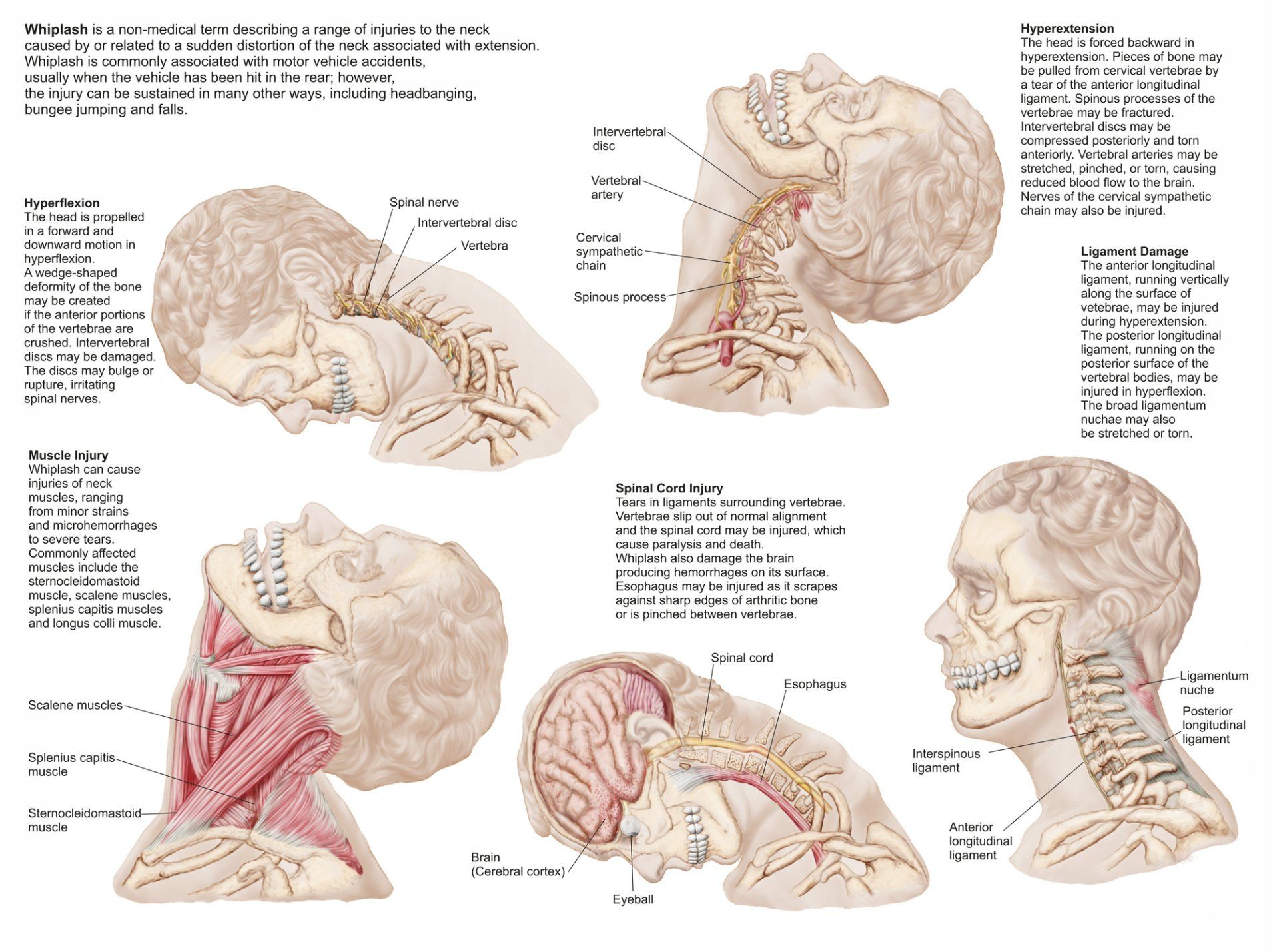 Person with Arm Bracing — DFW, TX — Texas Non-Surgical Orthopedic