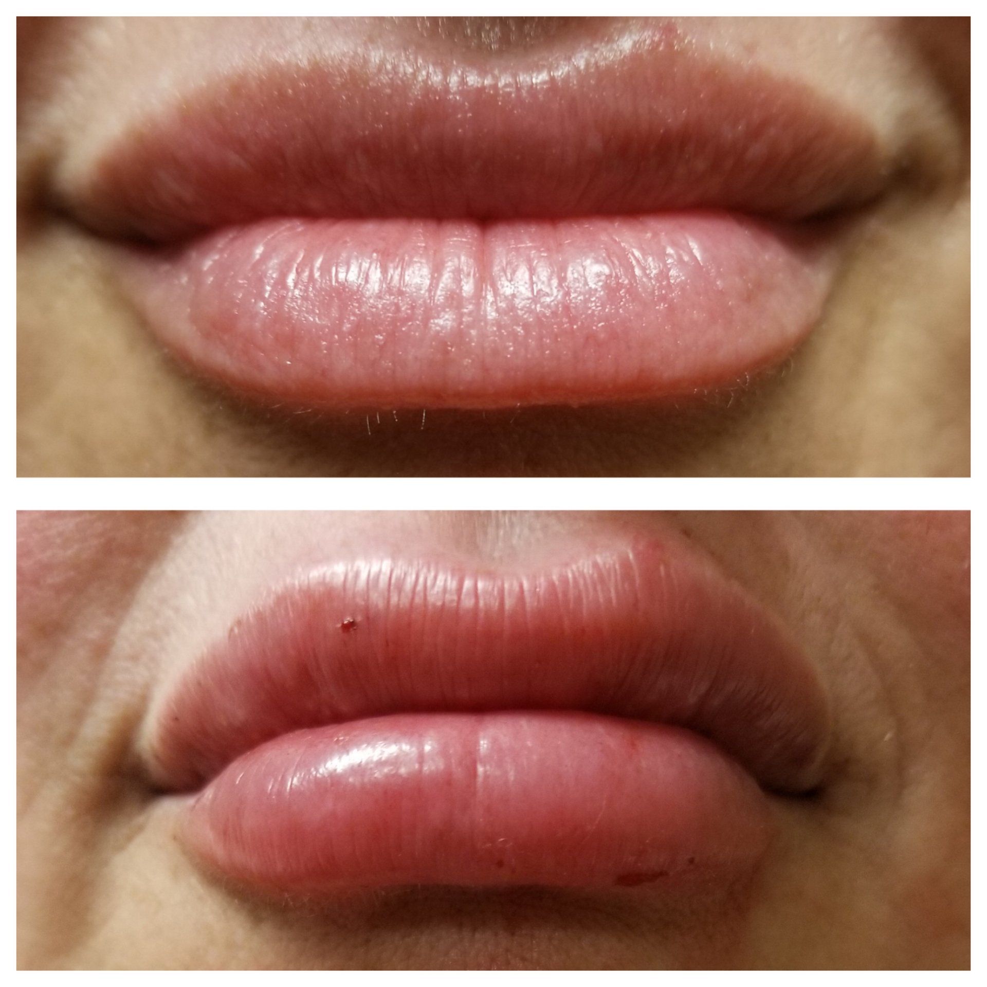 Two photos of a person's lips before and after a lip augmentation. The bottom lip appears more swollen in the after photo.