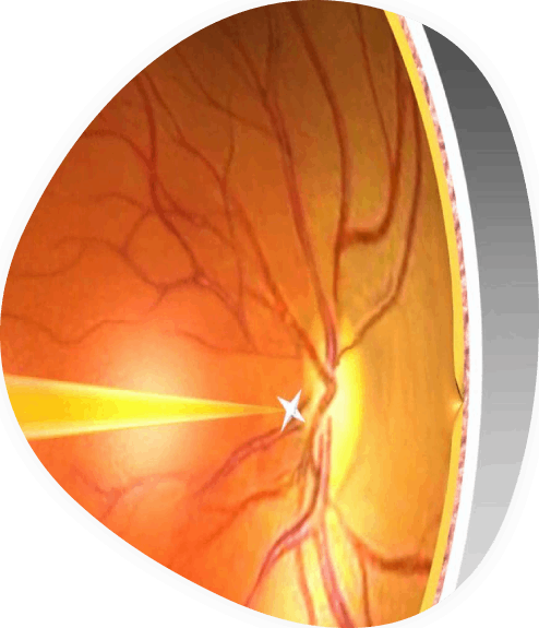 Colour Vision Defect