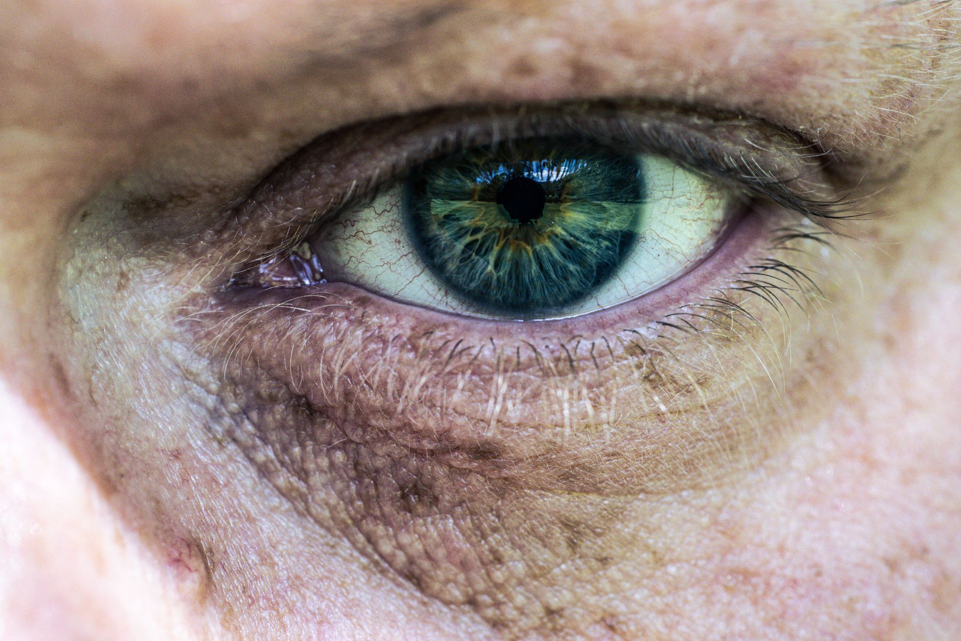 Dark Spot on Eye White