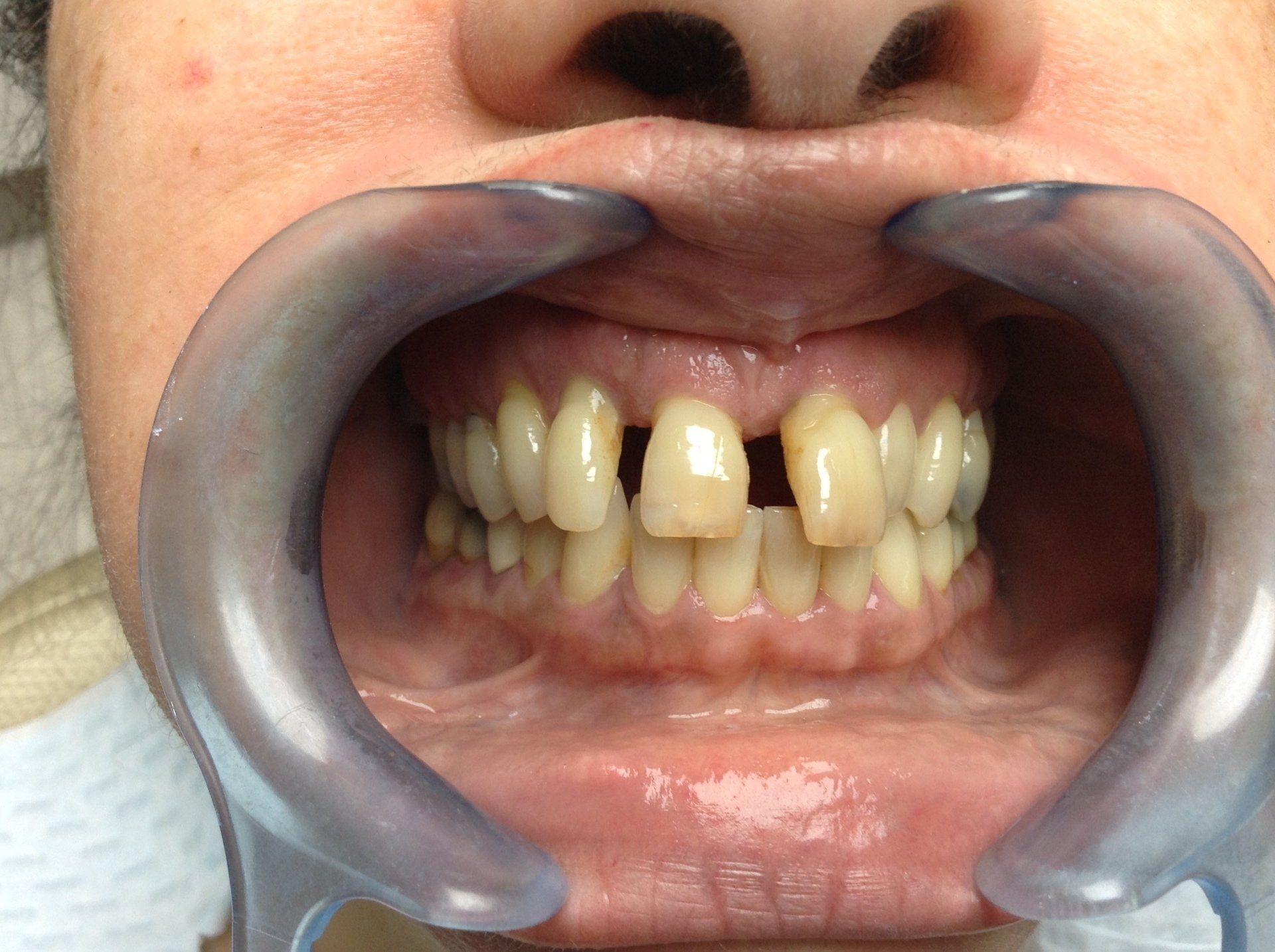 all on 6 implants before