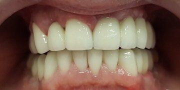 After Zirconium crown work in hungary