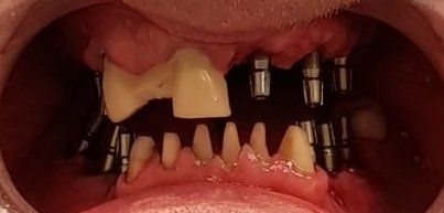 Before Zirconium crown work in hungary