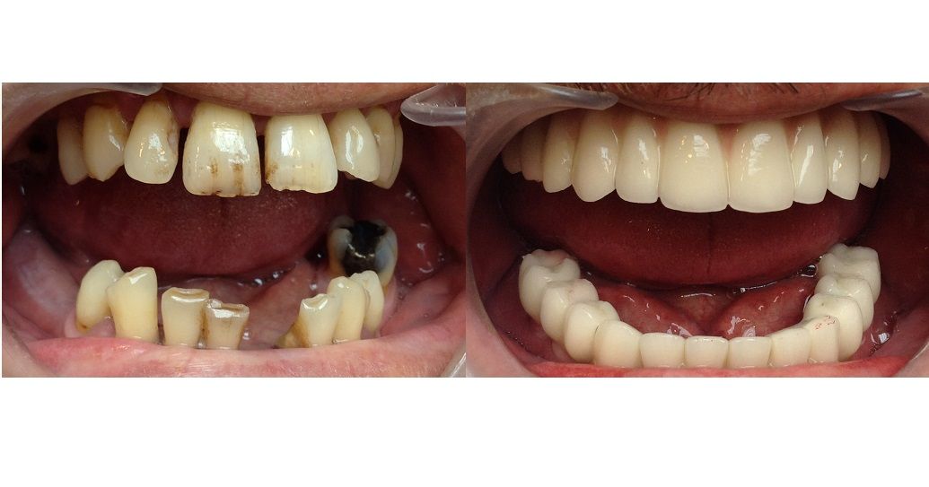 Full mouth Dental implant restorations hungary