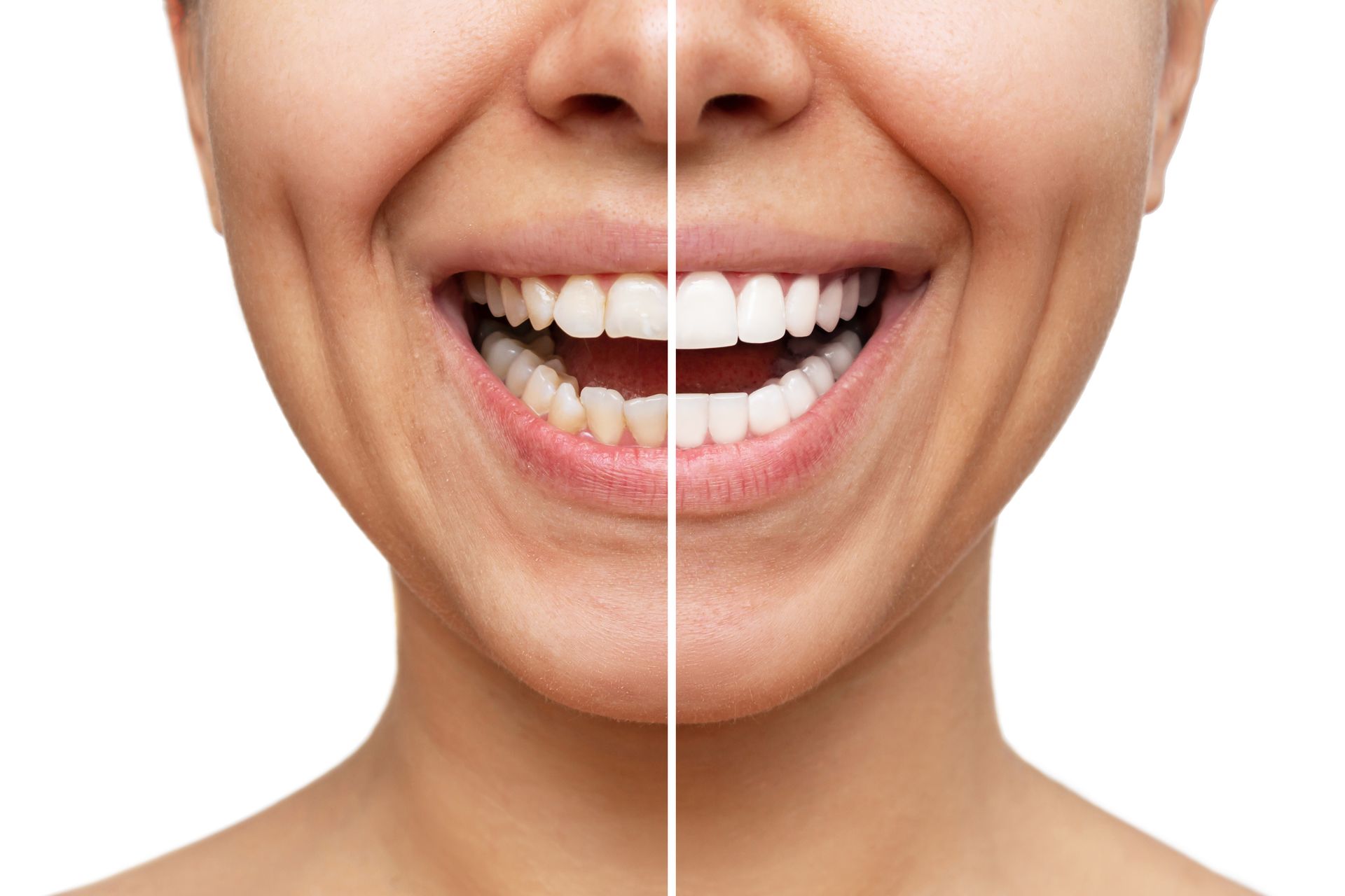 A cropped shot of a smiling woman with before and after veneer installation on a white background.