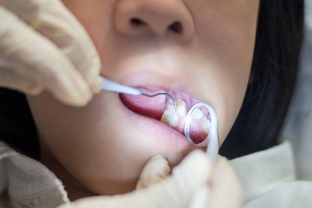 Dentist's gloved hands examining the patient's teeth with tools. Mouth open, dental mirror in use.