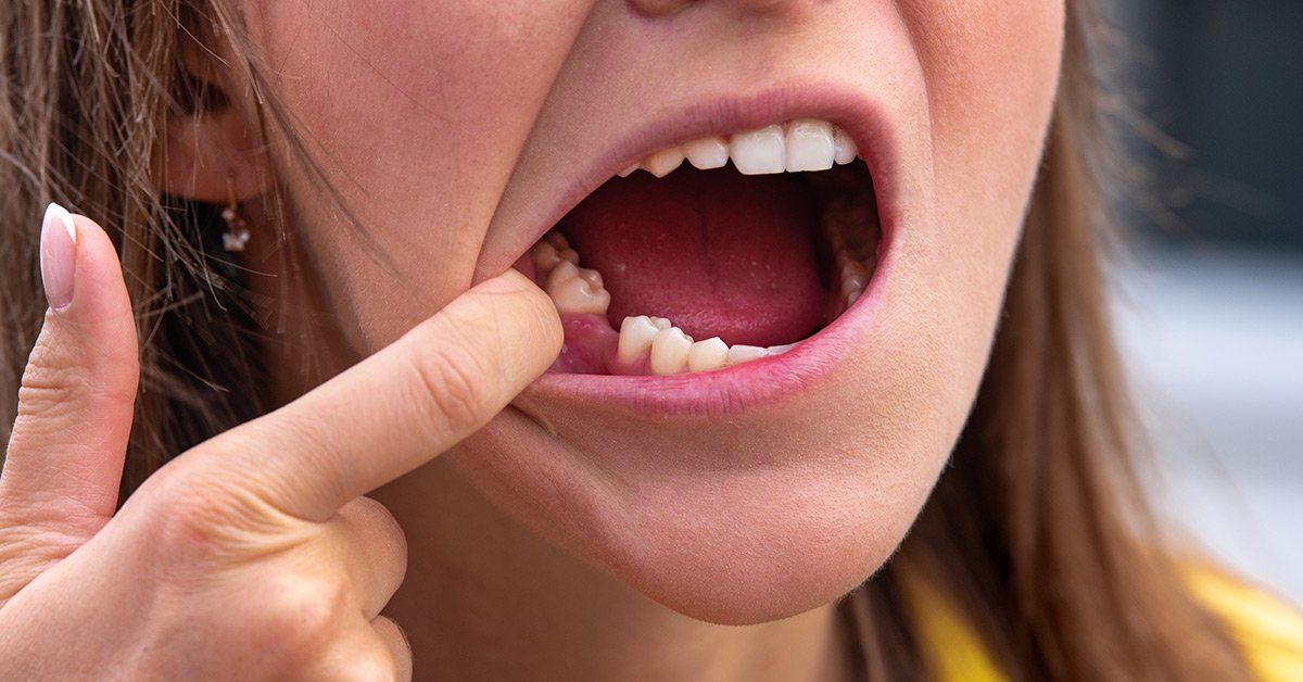 how to replace a missing tooth