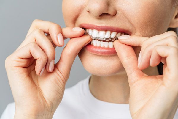 A complete guide to professional tooth whitening 
