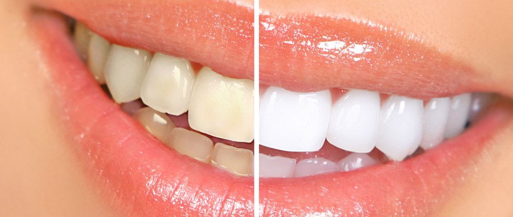 Close-up of a smiling mouth, showing teeth before and after whitening treatment.