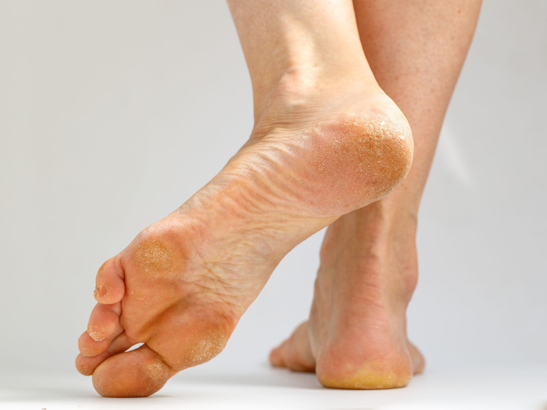 Bare feet with dry, cracked heels, viewed from behind.