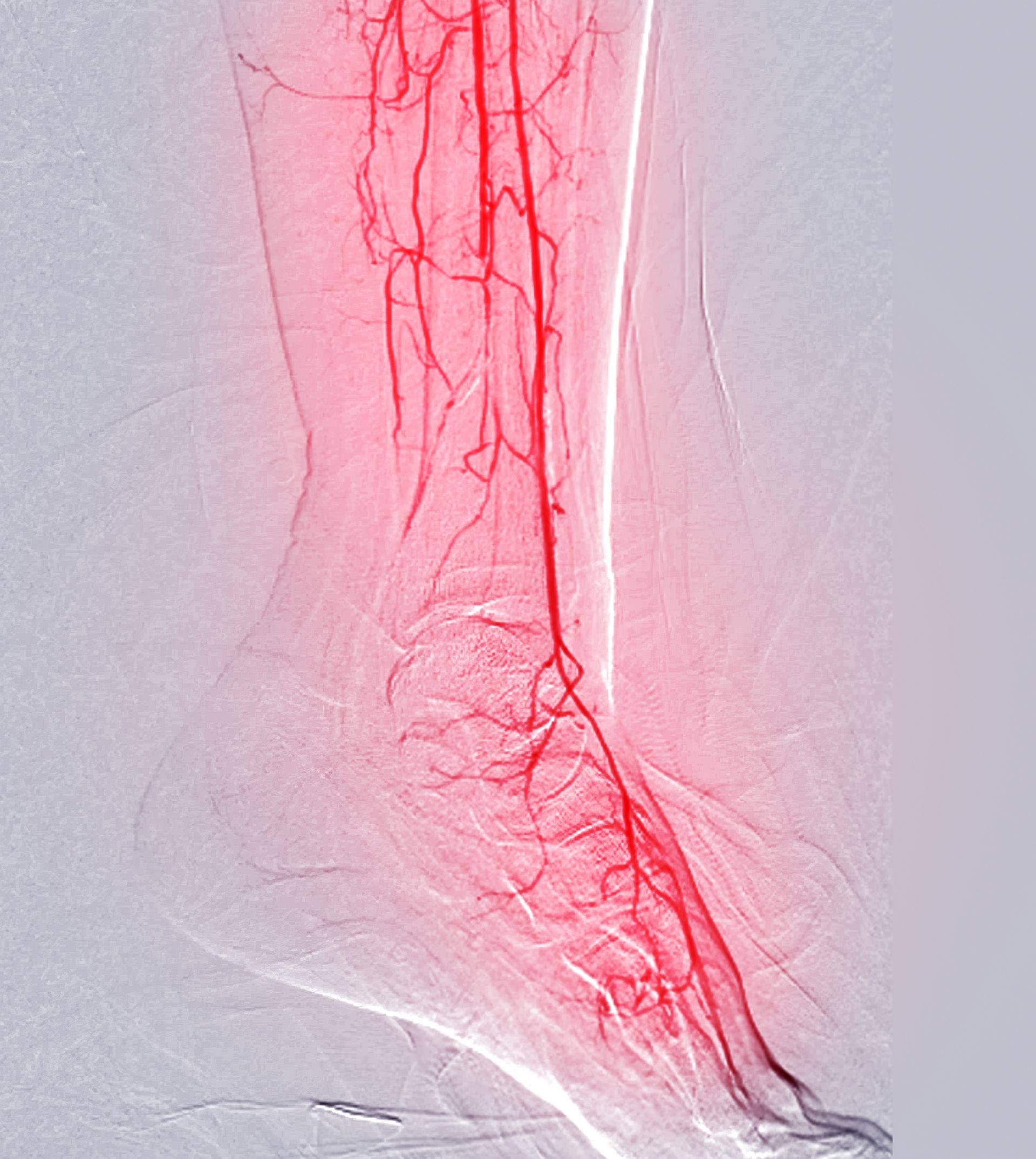 Angiogram of a leg, red blood vessels highlighted against a grey background.