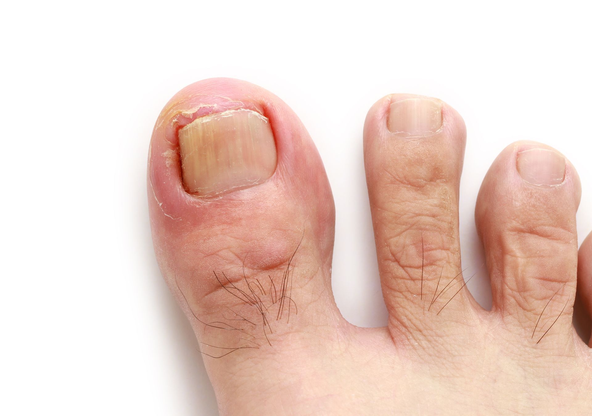 Toe with a damaged, discolored toenail, possibly infected.