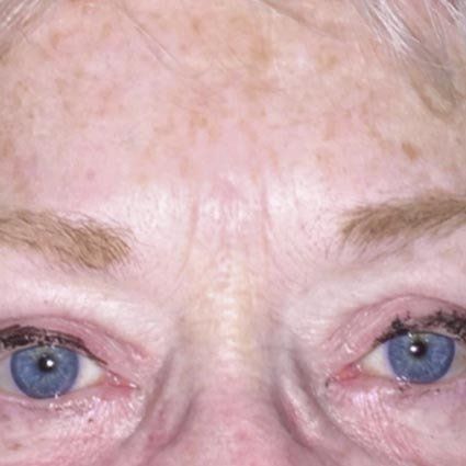 After Brow Procedure