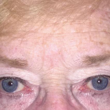 Before Brow Procedure