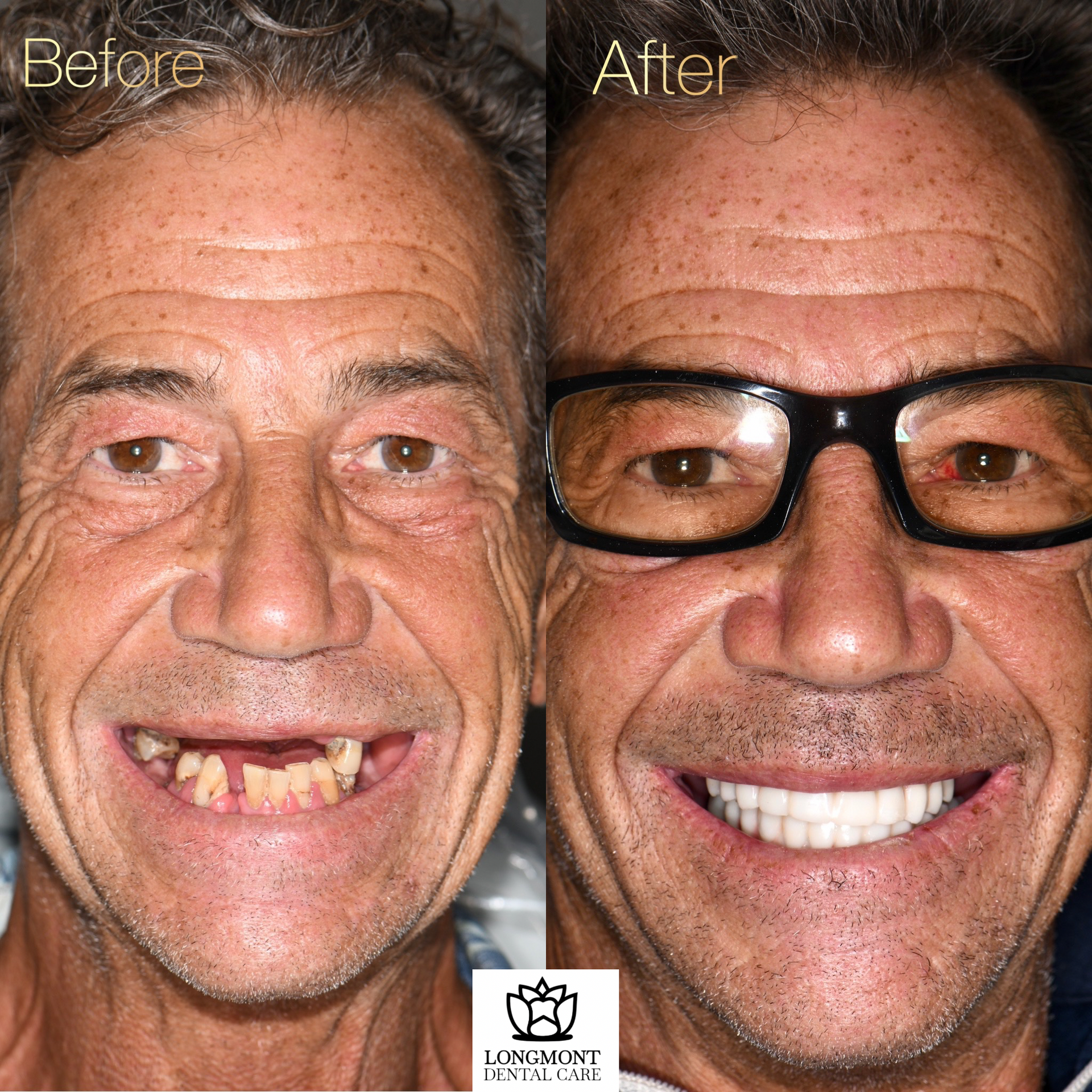 Before and After Dental Implants on Man | Family Dentist in Longmont CO