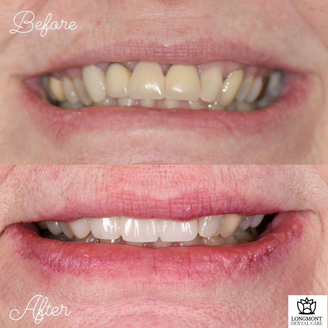 Before and After of Veneers and Dental Crowns | Longmont Dentist Smile Makeover