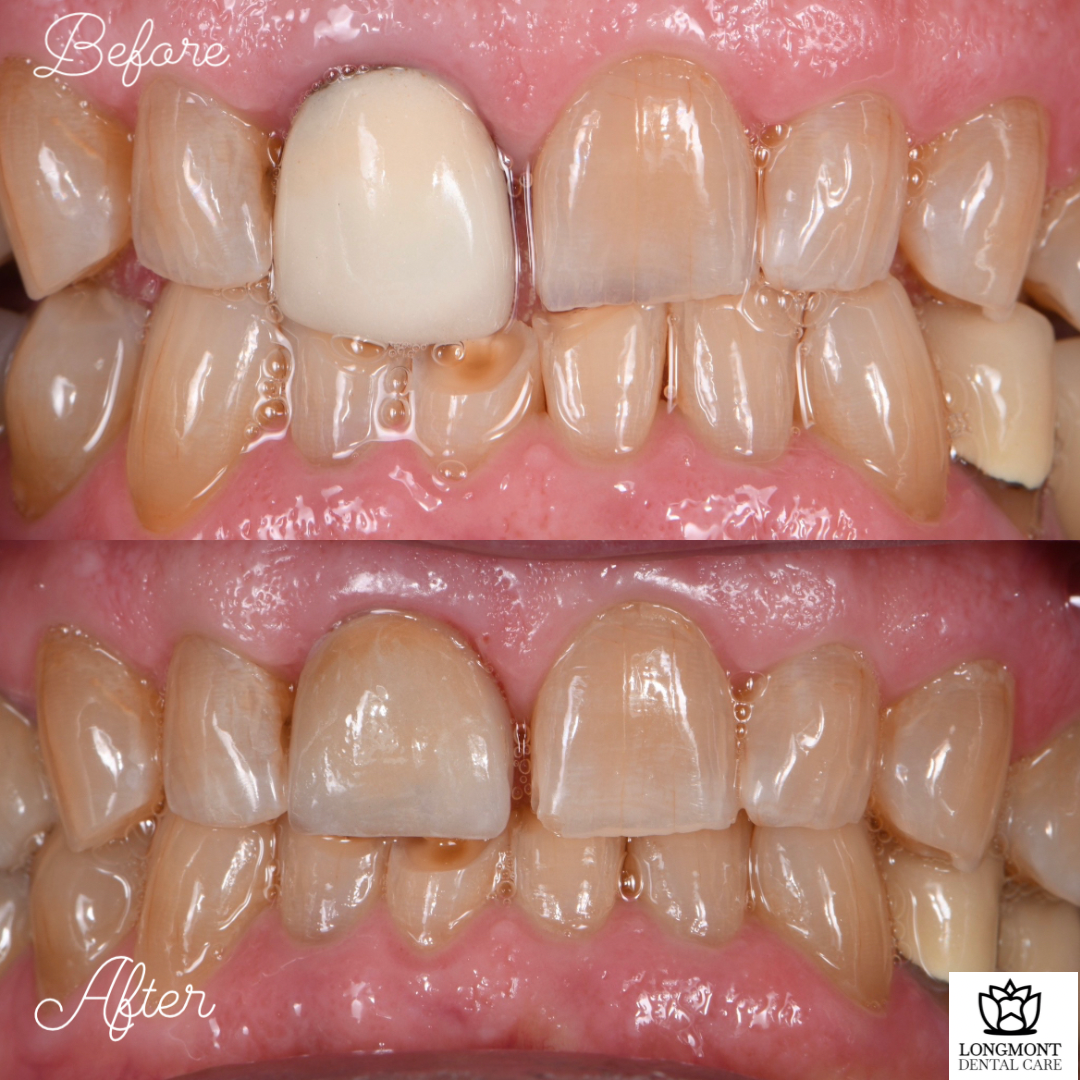 Before and After of Veneers and Dental Crowns | Longmont Dentist Smile Makeover