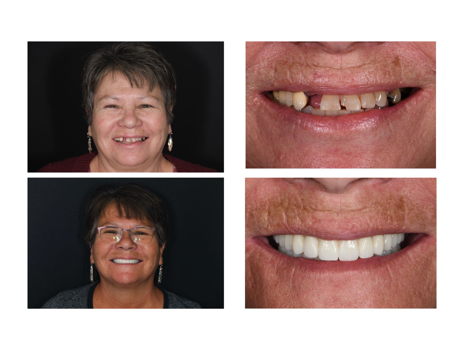 Before and after of dental implants from our top dentist near Longmont CO 80501