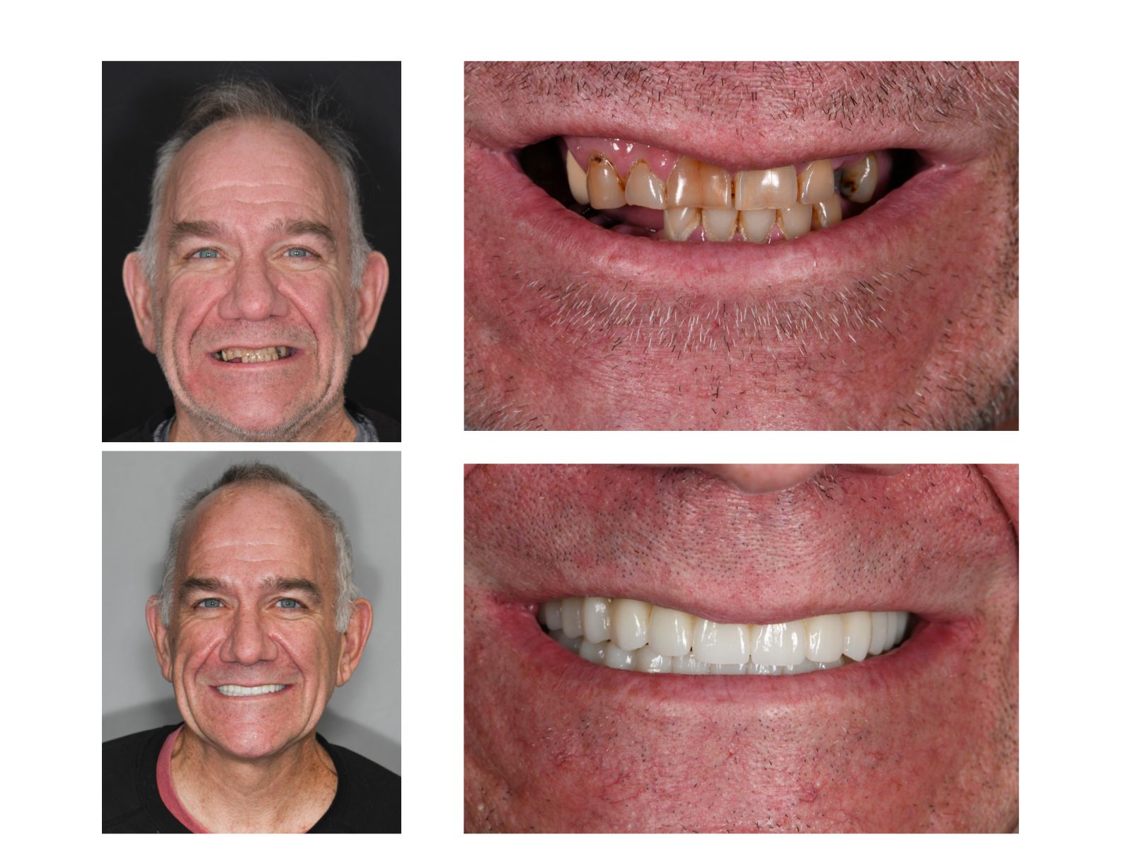 Before and after dental photos of a man with severely damaged teeth, then with a bright, white smile.