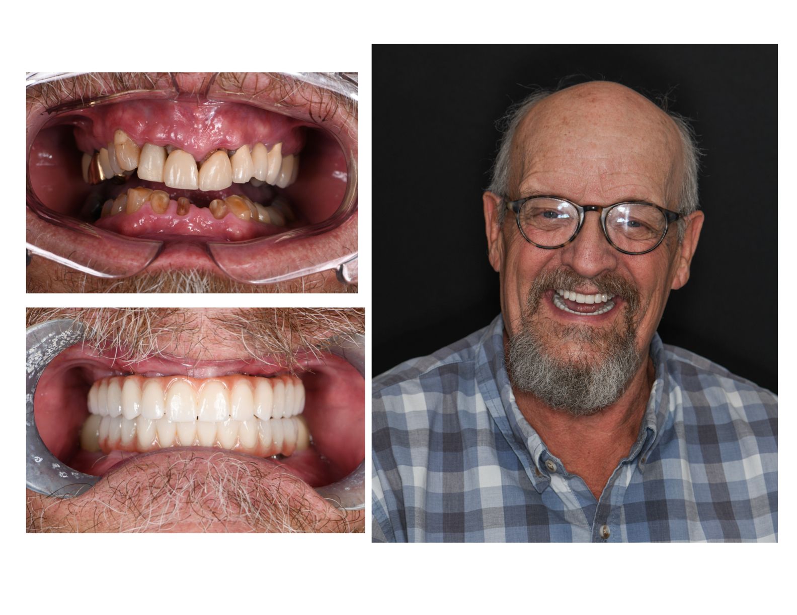 Man with before/after dental work: worn teeth compared to a bright, new smile.